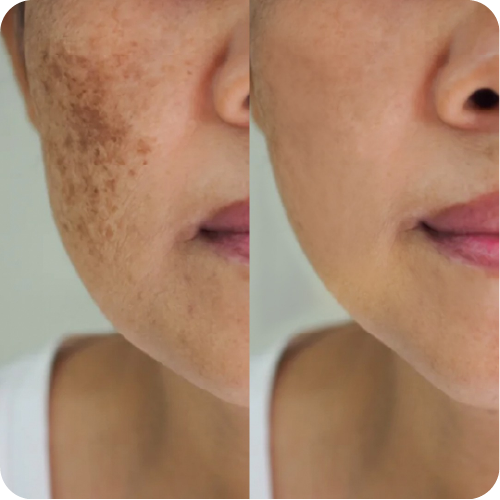 Sulis life before after pico laser 1
