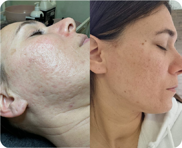 Sulis life before after pico laser 2